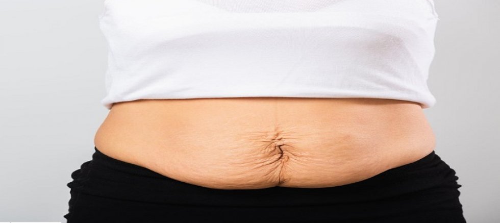 Doğum Kilolarınız Gitti Ama Göbeğiniz Gitmedi mi? Sorun Yağ Değil, 