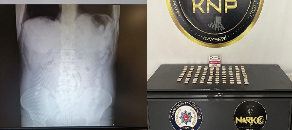 Kayseri'de yabancı uyruklu şahsın midesinden 729 gram uyuşturucu madde elegeçirildi