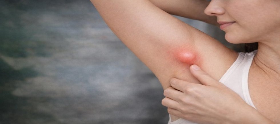 Koltuk Altındaki Şişlik Her Zaman Masum Değil: Ektopik Meme Dokusu Uyarısı