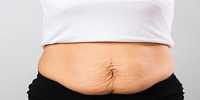 Doğum Kilolarınız Gitti Ama Göbeğiniz Gitmedi mi? Sorun Yağ Değil, 