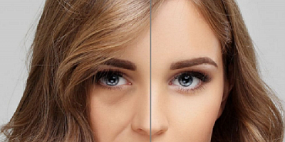 Göz Kapağı Ameliyatı, Sağlık ve Estetik İçin Tercih Ediliyor