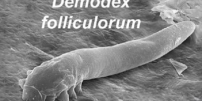 Gözde Yanma, Sulanma ve Kaşıntı Varsa Demodex Parazitine Dikkat !