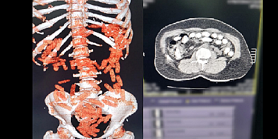 Kayseri'de bir kişinin midesinden 88 kapsül halinde uyuşturucu madde ele geçirildi